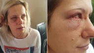 Жительница Италии, проживающая в Италии, была жестоко избита гражданином Молдовы, который был ее соседом по комнате